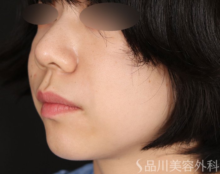 症例NO.71931のAFTER写真