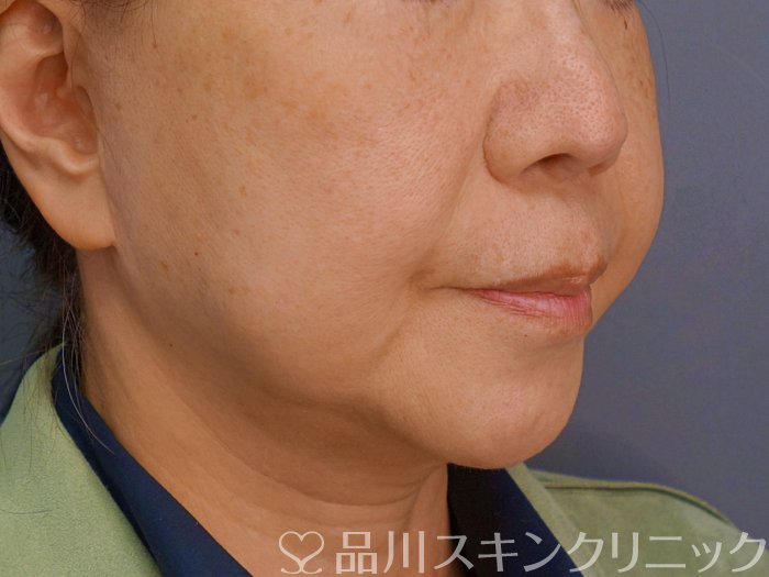 症例NO.74696のBEFORE写真