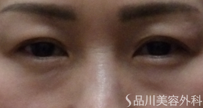 症例NO.68455のBEFORE写真