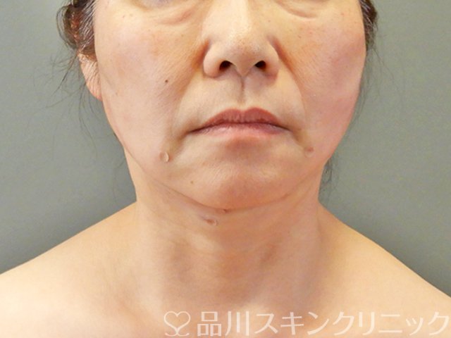 症例NO.67753のAFTER写真