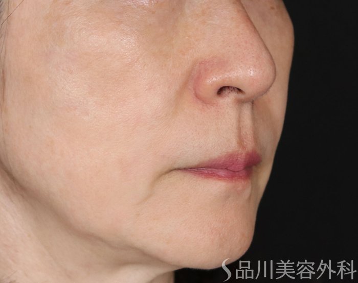 症例NO.71328のBEFORE写真