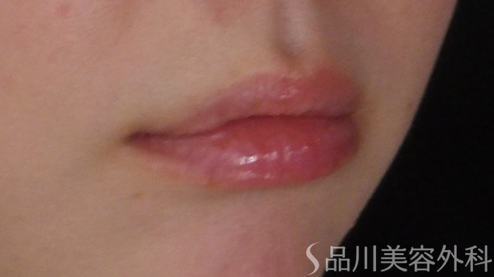 症例NO.67957のBEFORE写真
