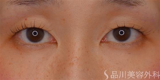 症例NO.60437のBEFORE写真