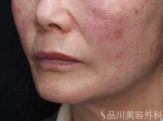 症例NO.73619のAFTER写真