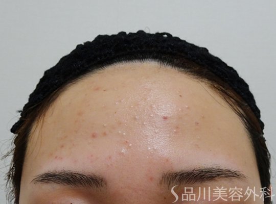 症例NO.71186のBEFORE写真