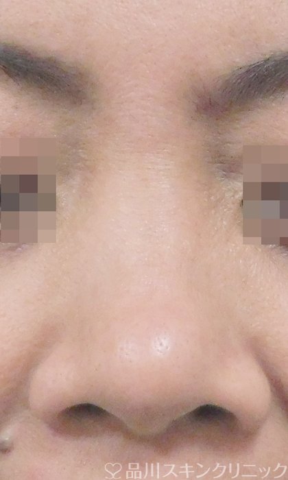 症例NO.67732のBEFORE写真