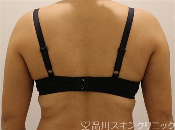 症例NO.41257のAFTER写真