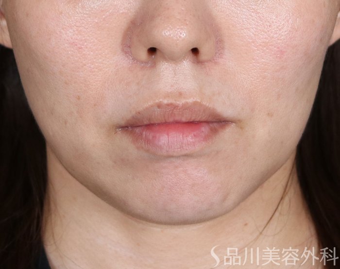 症例NO.74263のBEFORE写真