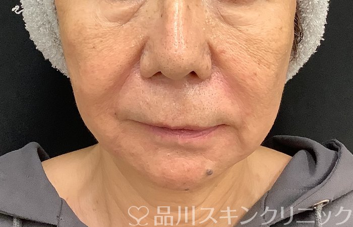 症例NO.67983のAFTER写真