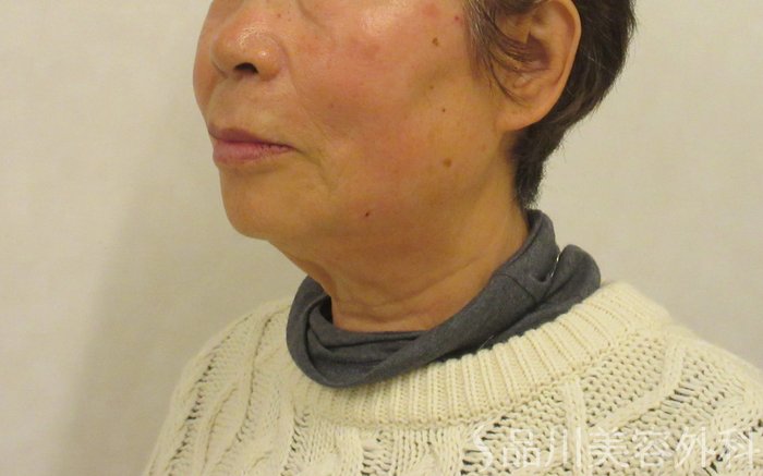 症例NO.72253のAFTER写真