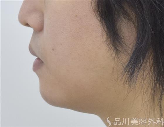 症例NO.47916のAFTER写真