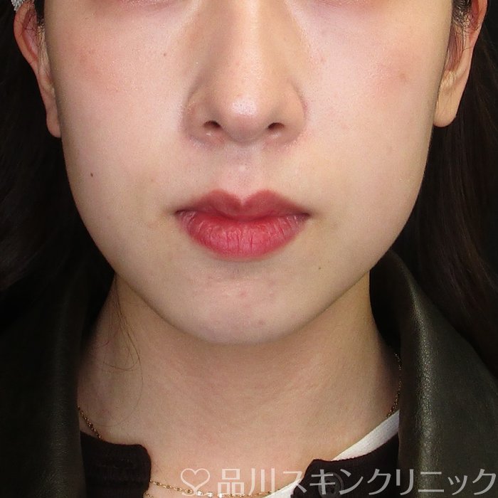 症例NO.73436のAFTER写真