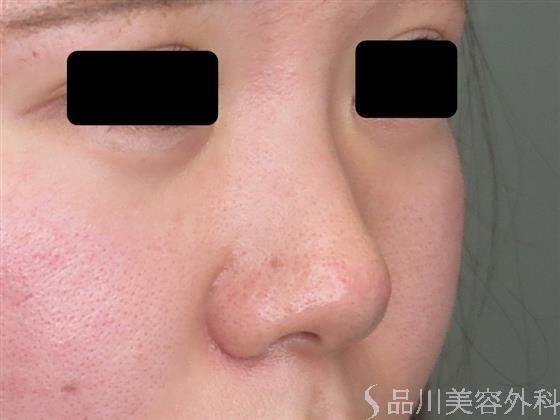 症例NO.47184のBEFORE写真