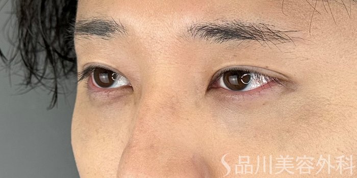 症例NO.72839のAFTER写真