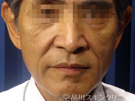症例NO.32760のBEFORE写真