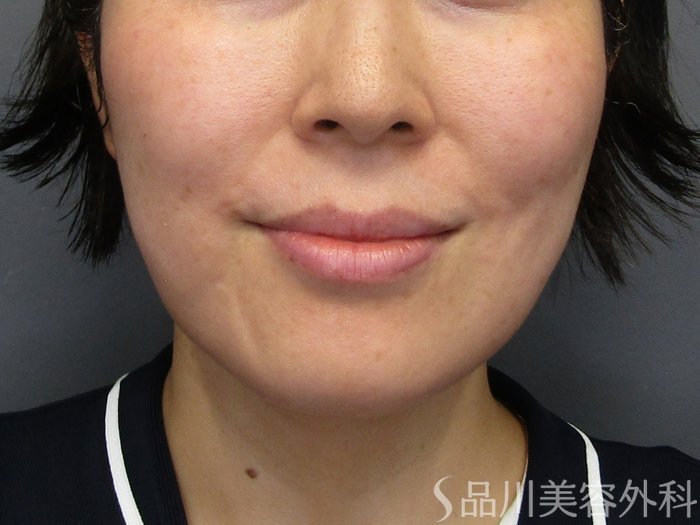 症例NO.75162のBEFORE写真