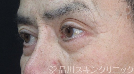 症例NO.70411のAFTER写真