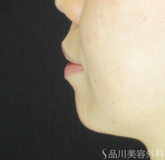 症例NO.70048のBEFORE写真