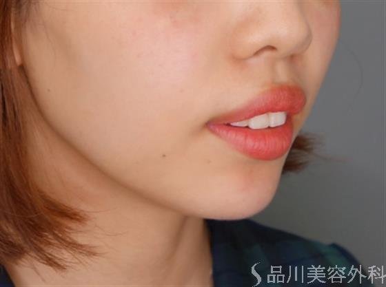 症例NO.52312のAFTER写真