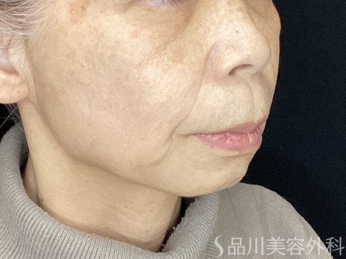 症例NO.72092のAFTER写真