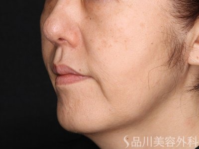 症例NO.72074のAFTER写真