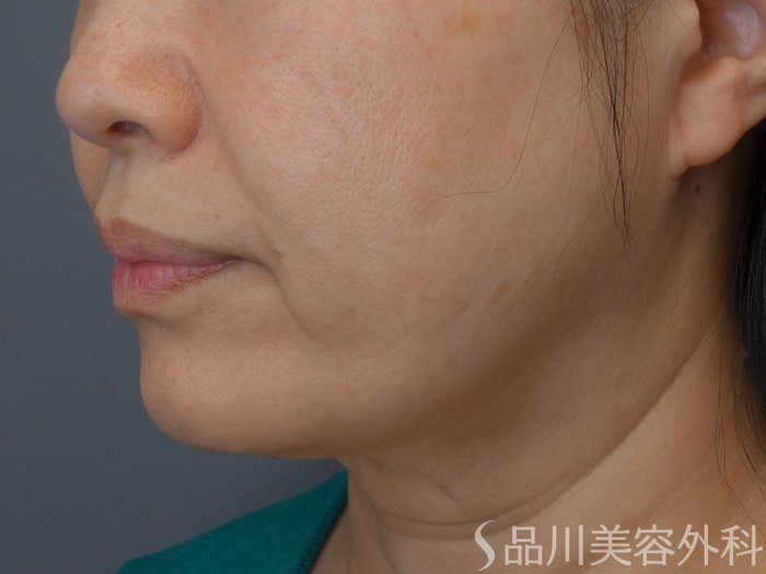 症例NO.72933のBEFORE写真