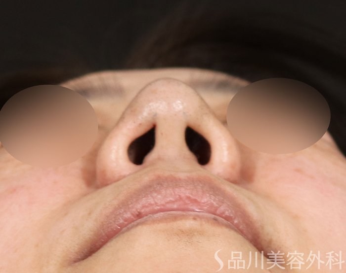 症例NO.72215のAFTER写真