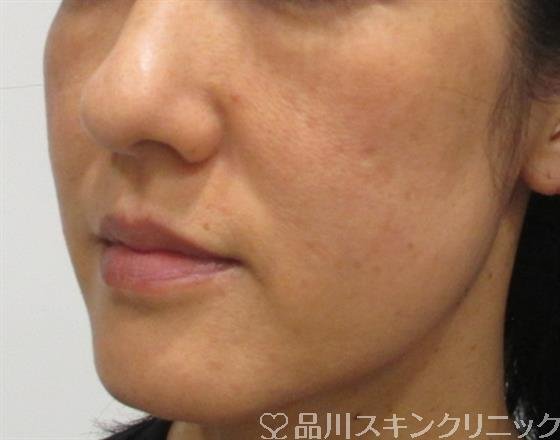 症例NO.32518のBEFORE写真