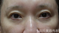 症例NO.72394のAFTER写真