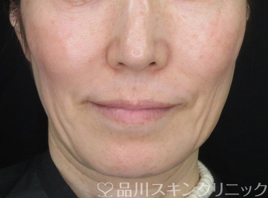 症例NO.69351のBEFORE写真
