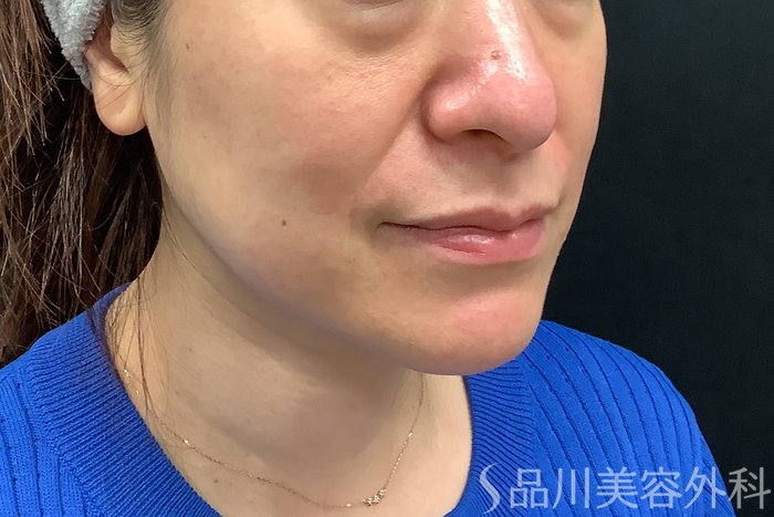 症例NO.71277のBEFORE写真