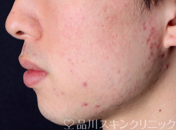 症例NO.73654のBEFORE写真