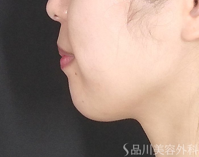 症例NO.65060のBEFORE写真