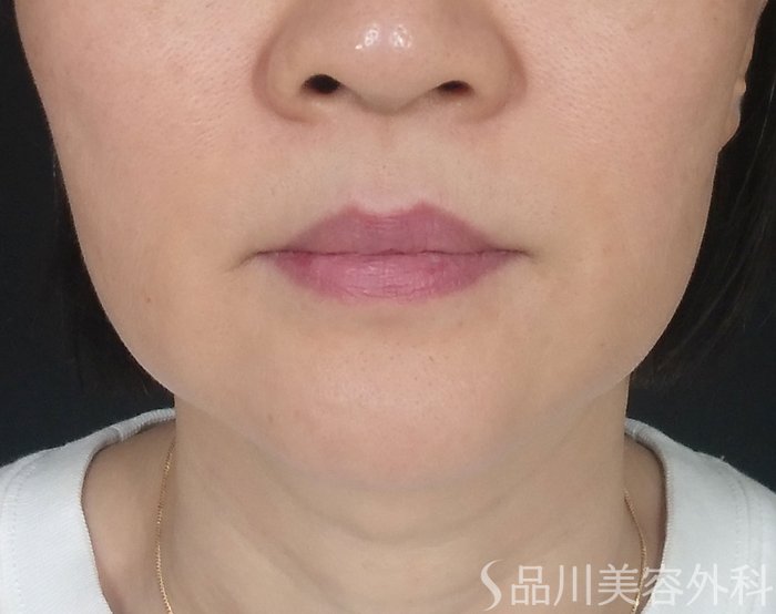 症例NO.69235のBEFORE写真