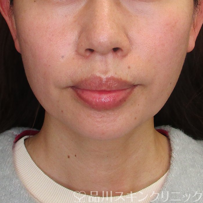 症例NO.73711のAFTER写真