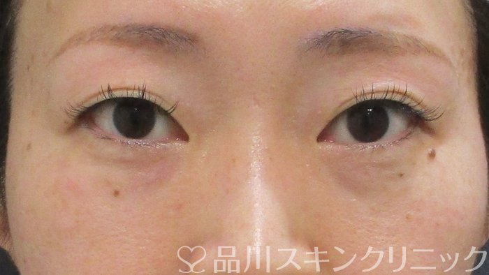 症例NO.70064のAFTER写真