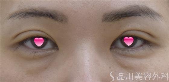 症例NO.52152のBEFORE写真