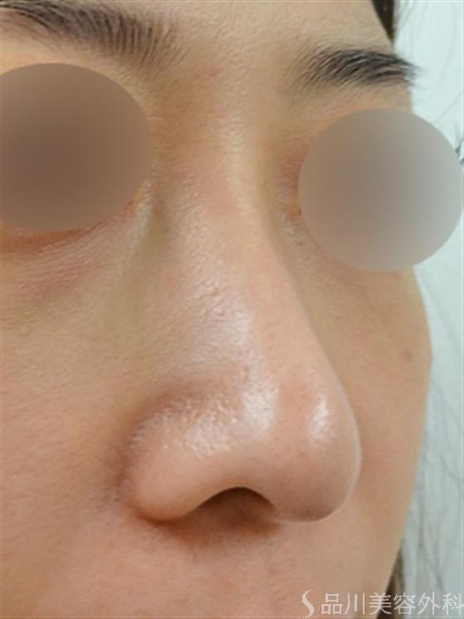 症例NO.25958のBEFORE写真
