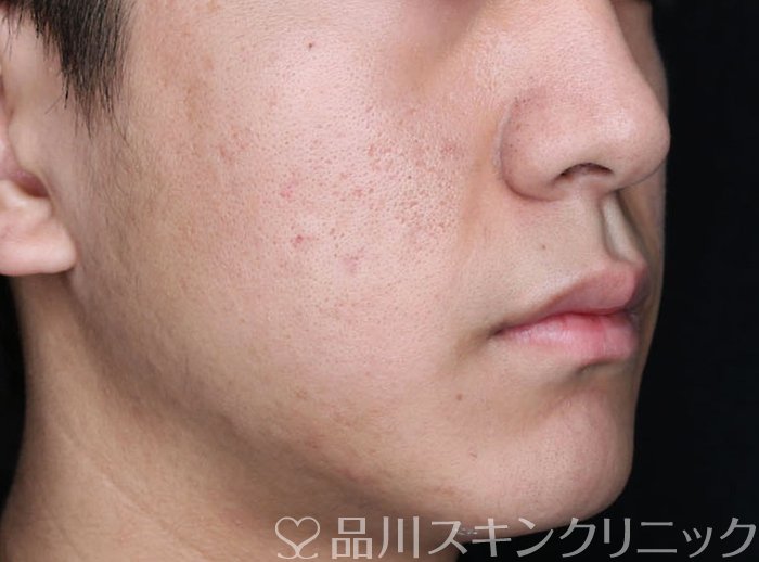 症例NO.66639のAFTER写真