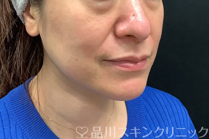 症例NO.71277のBEFORE写真