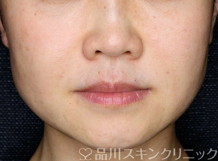 症例NO.64334のAFTER写真