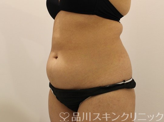 症例NO.65412のBEFORE写真