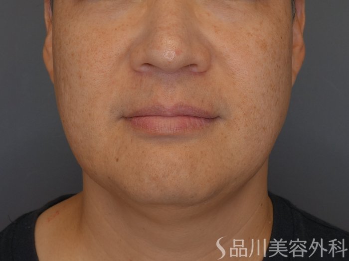 症例NO.73068のBEFORE写真