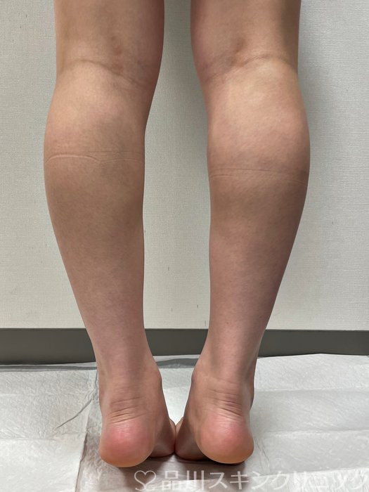 症例NO.73247のBEFORE写真