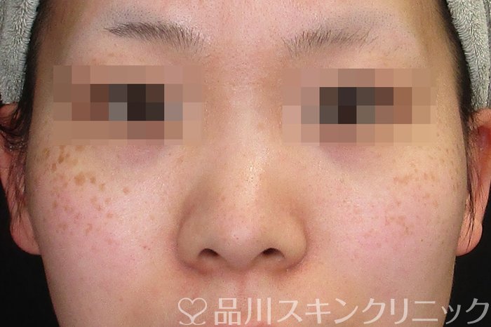 症例NO.74214のBEFORE写真