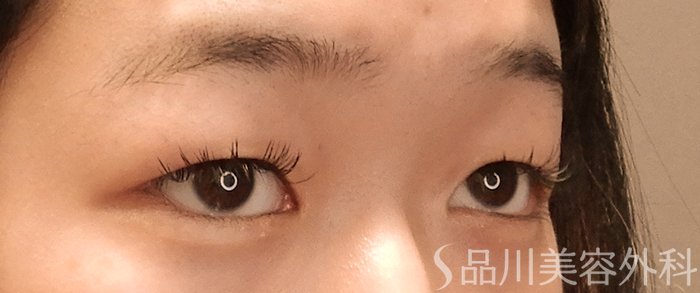 症例NO.70396のBEFORE写真
