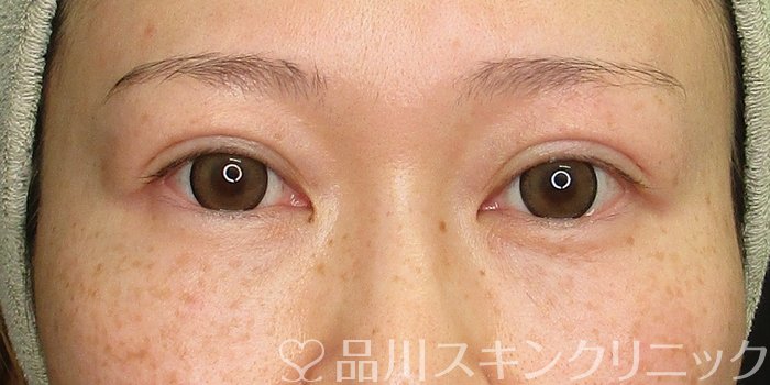 症例NO.70253のAFTER写真