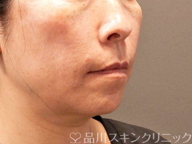 症例NO.70858のAFTER写真