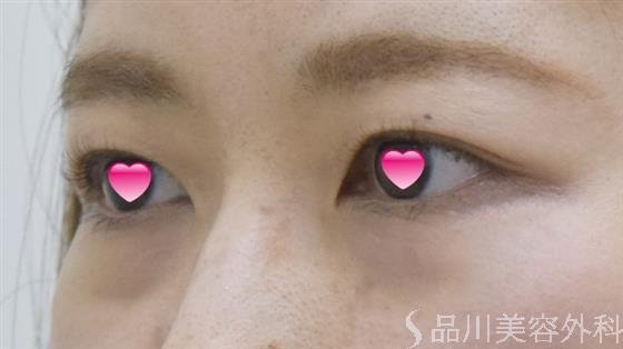 症例NO.52437のBEFORE写真