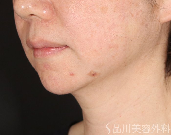 症例NO.72542のAFTER写真